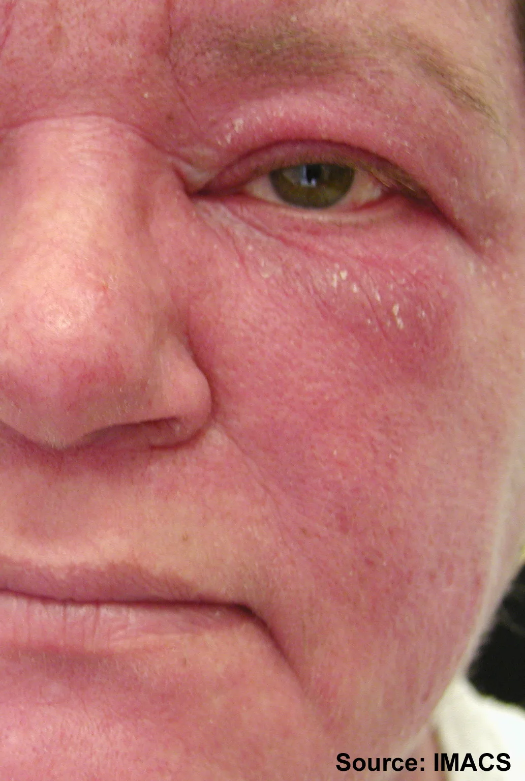 Dermatomyositis