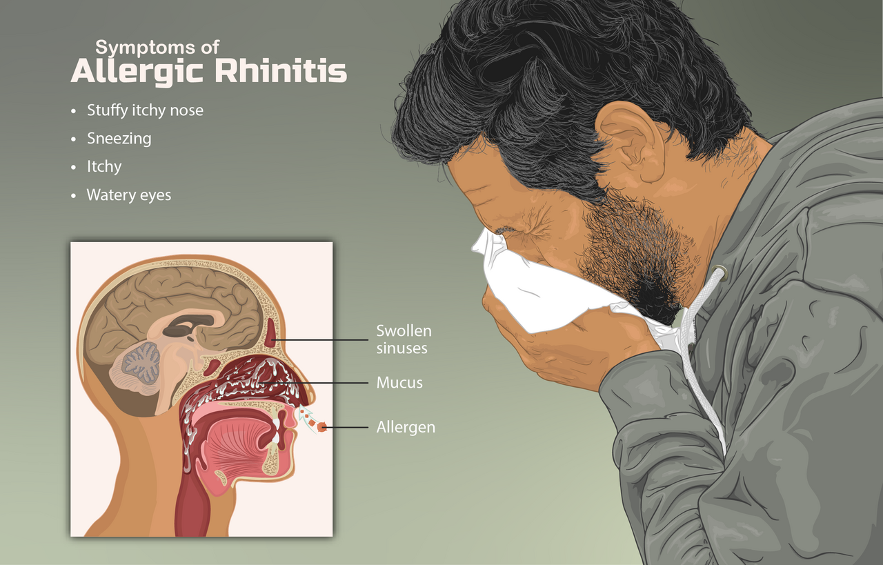Depiction of a person suffering from Allergic Rhinitis
