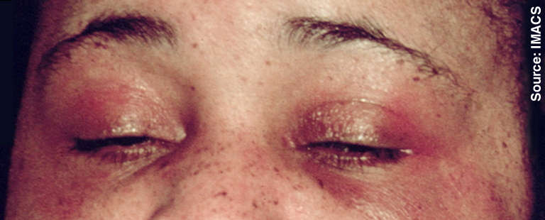 Dermatomyositis11