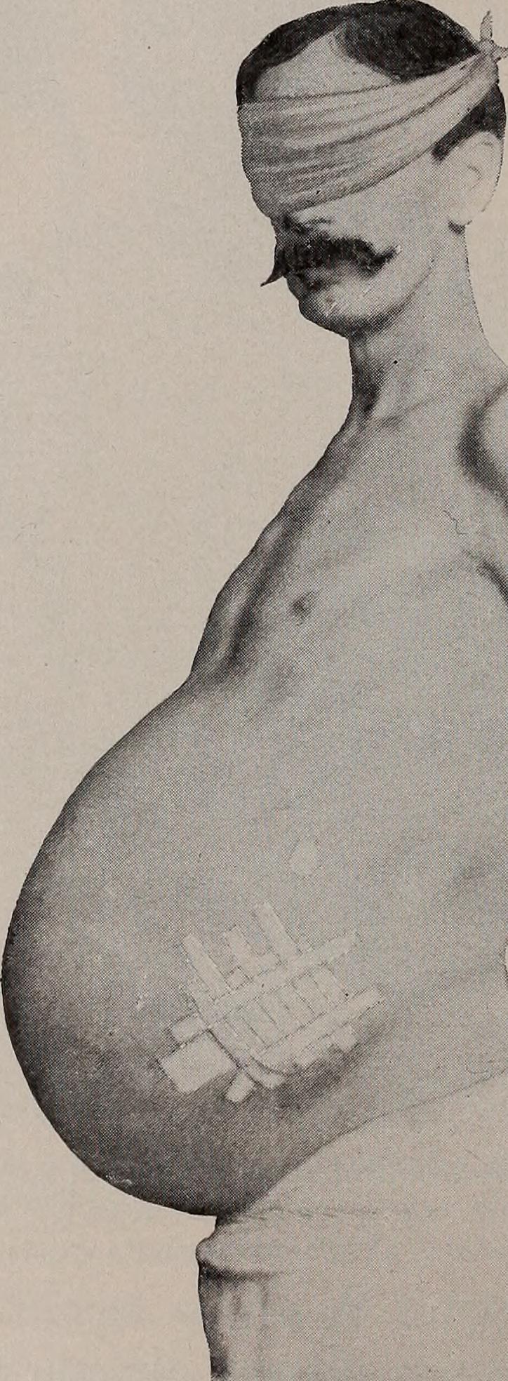 Ascites