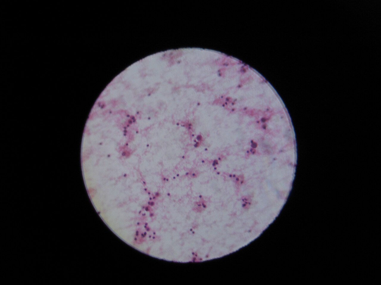 Ascites