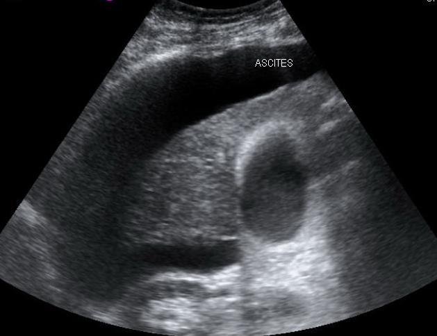 Ascites