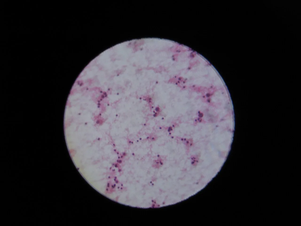 Ascites