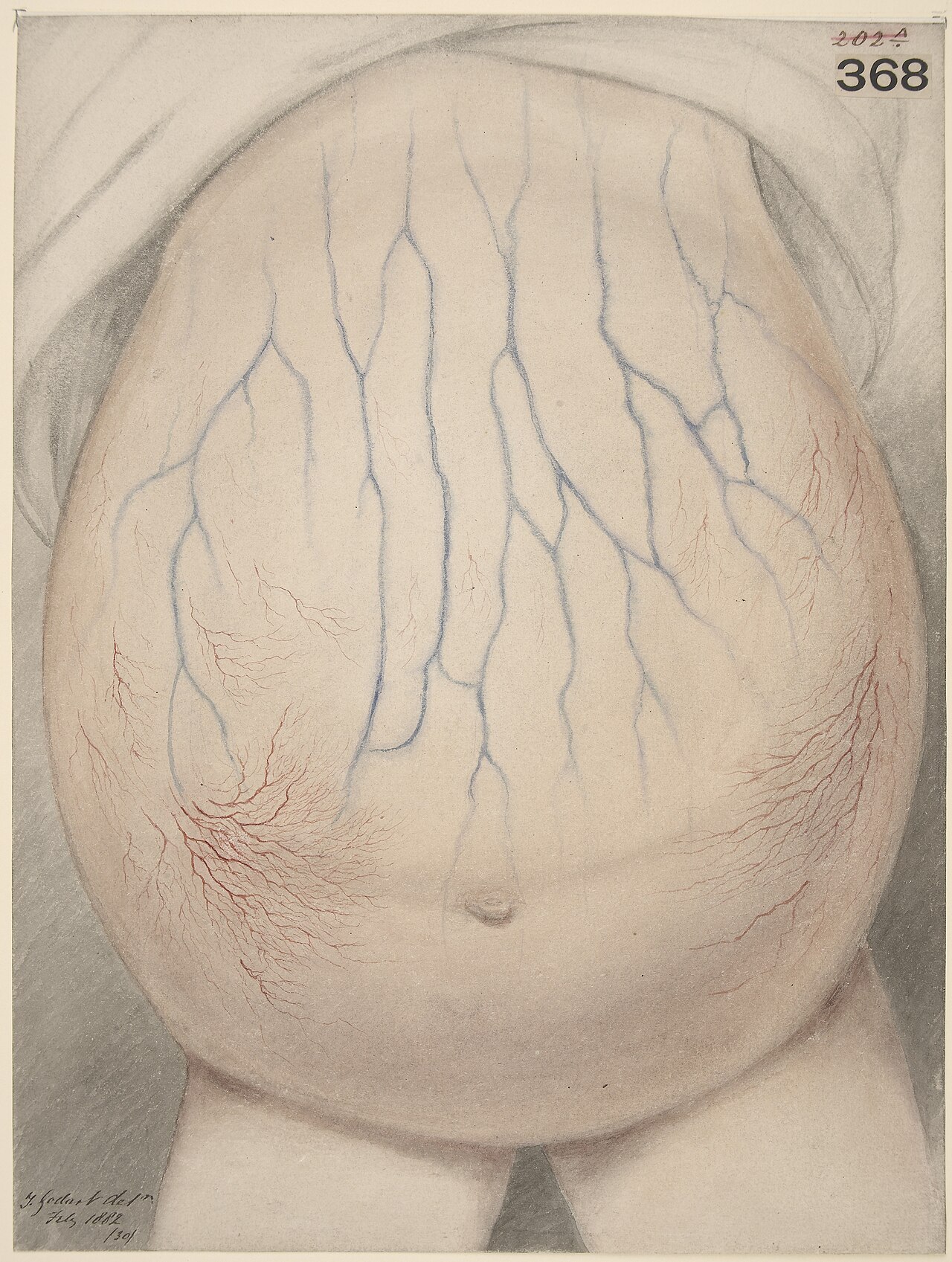 Abdomen of child affected with ascites Wellcome L0061575