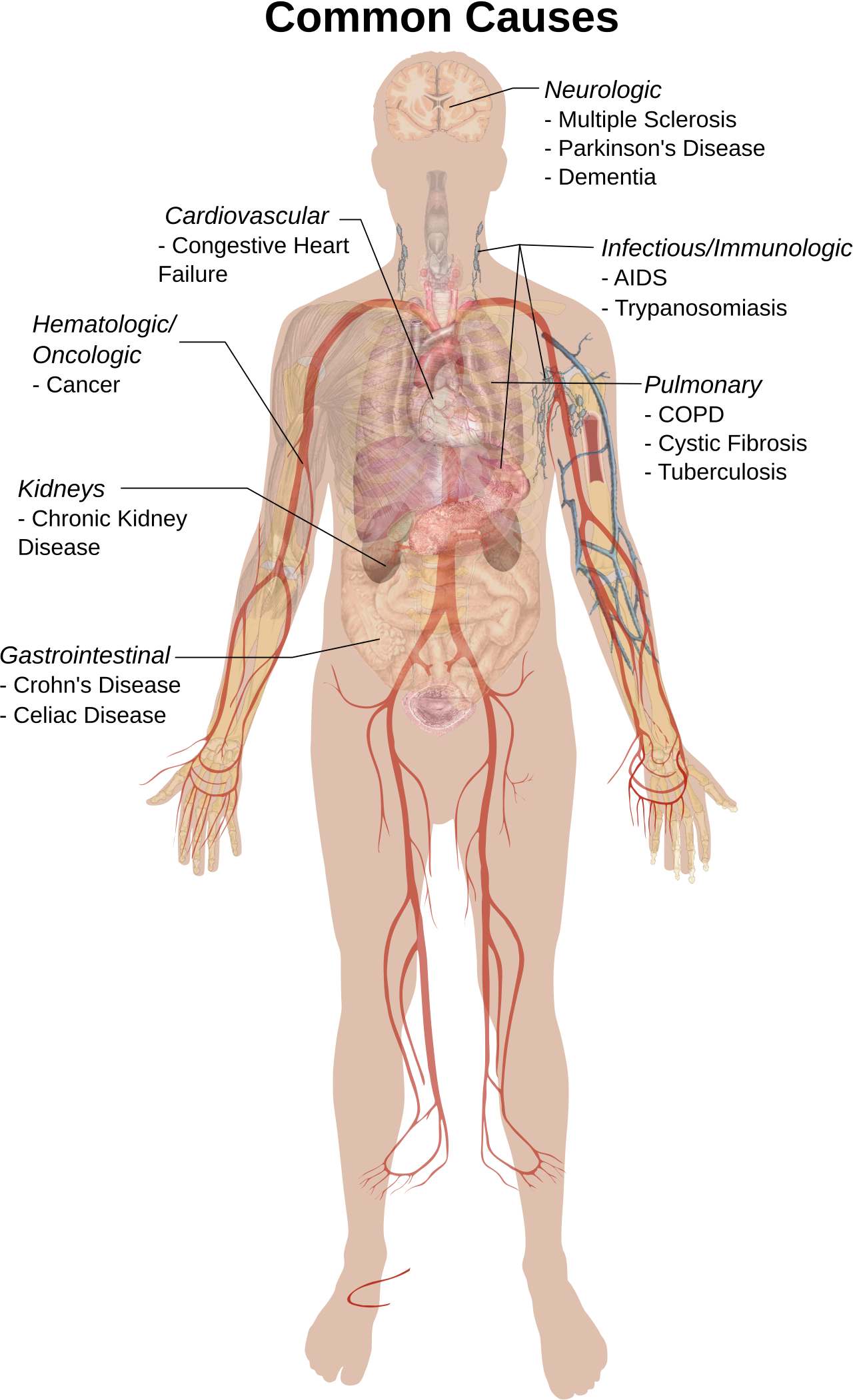 Cachexia Causes