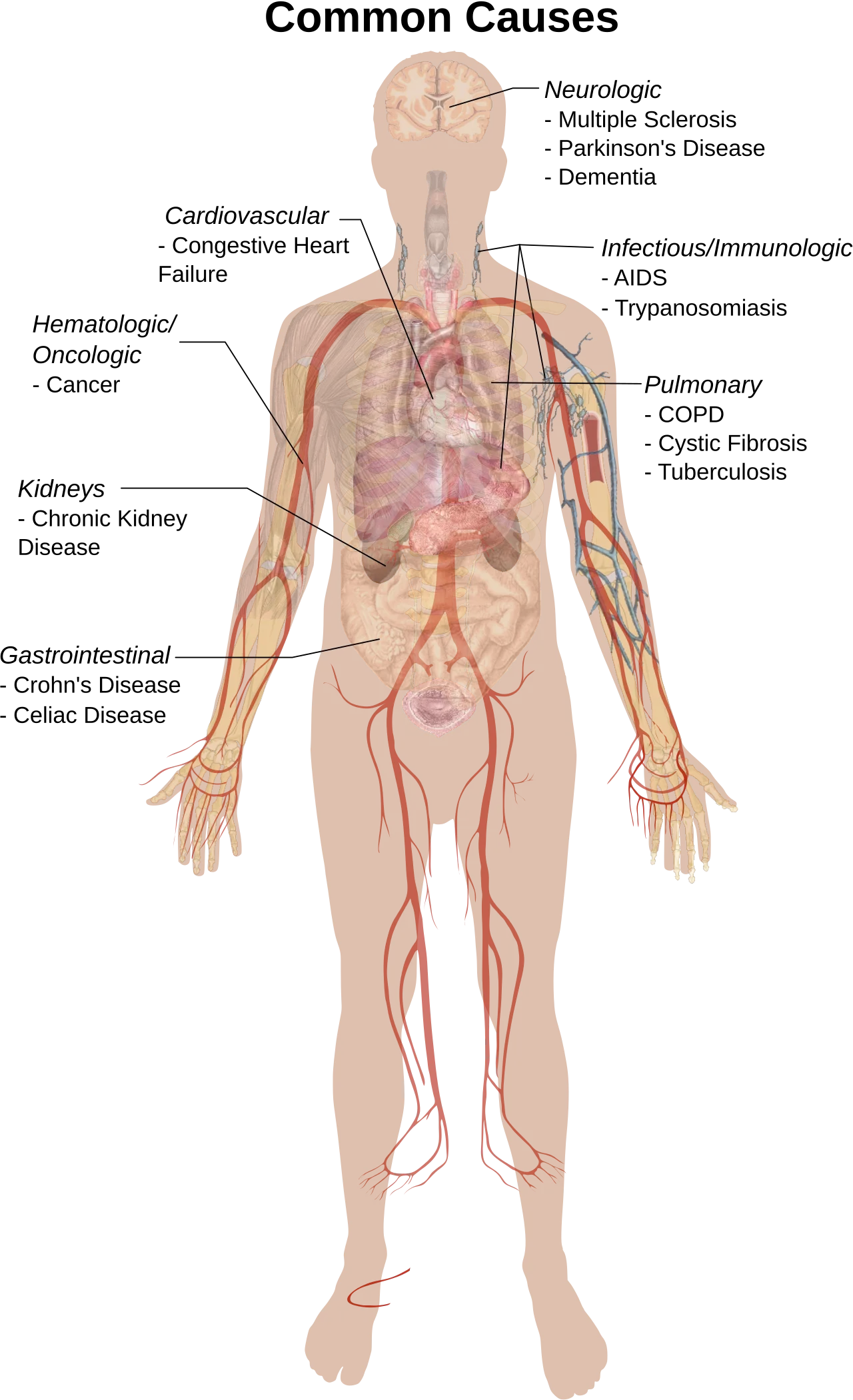 Cachexia