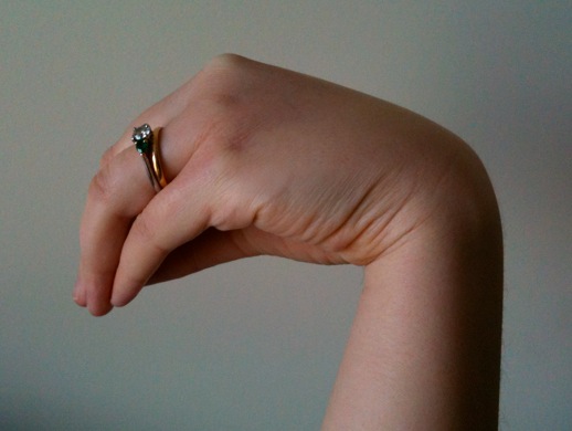 Troussau's Sign of Latent Tetany