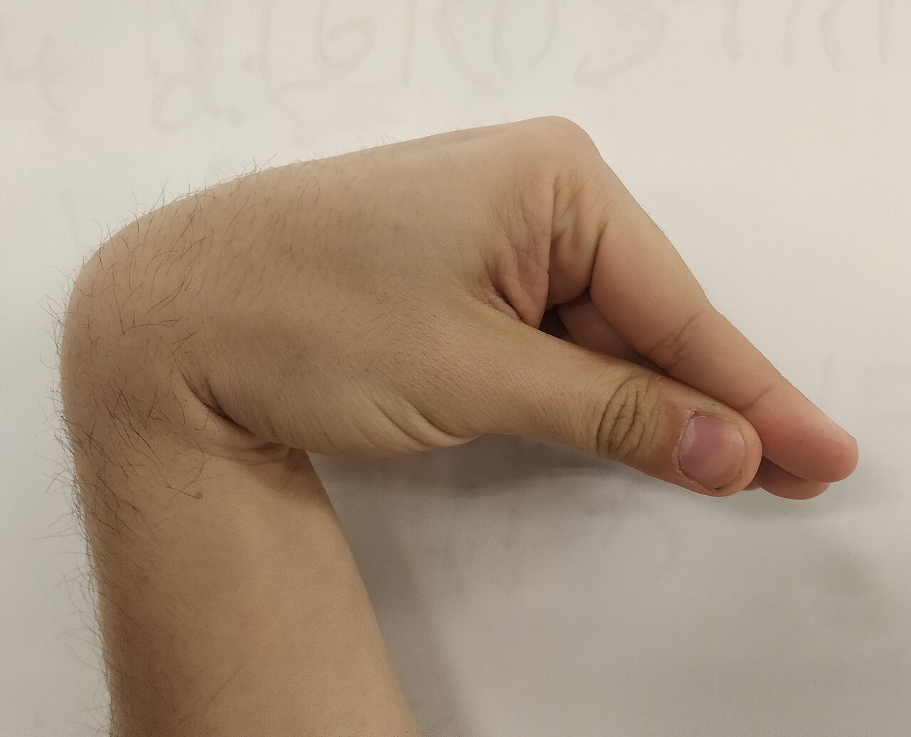 Trousseau's Sign of Latent Tetany