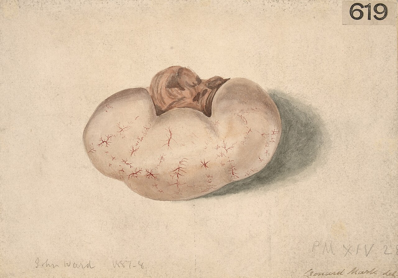 Anasarca