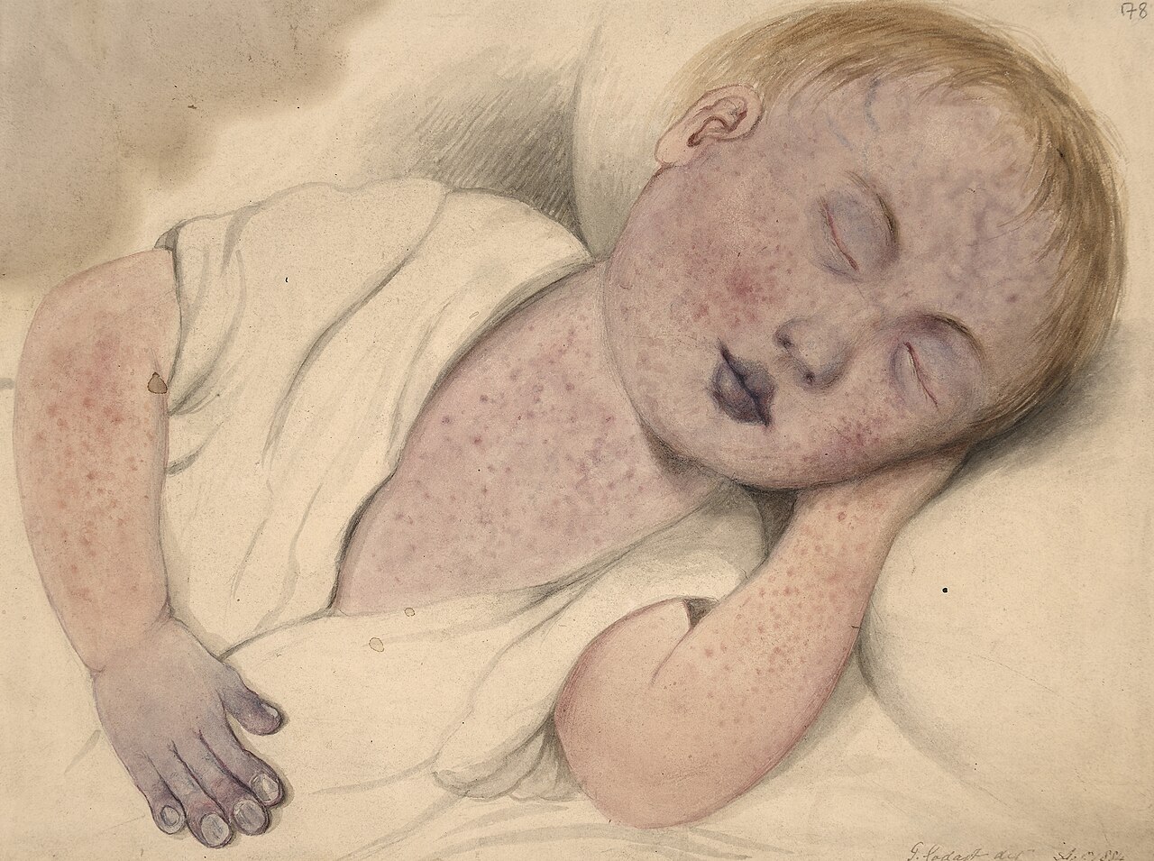 Cyanosis