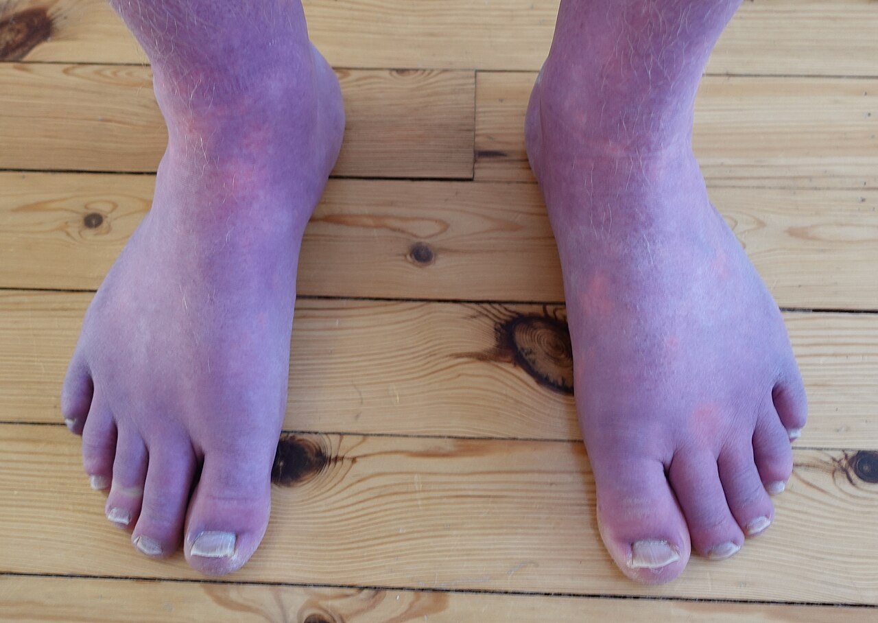 Cyanosis