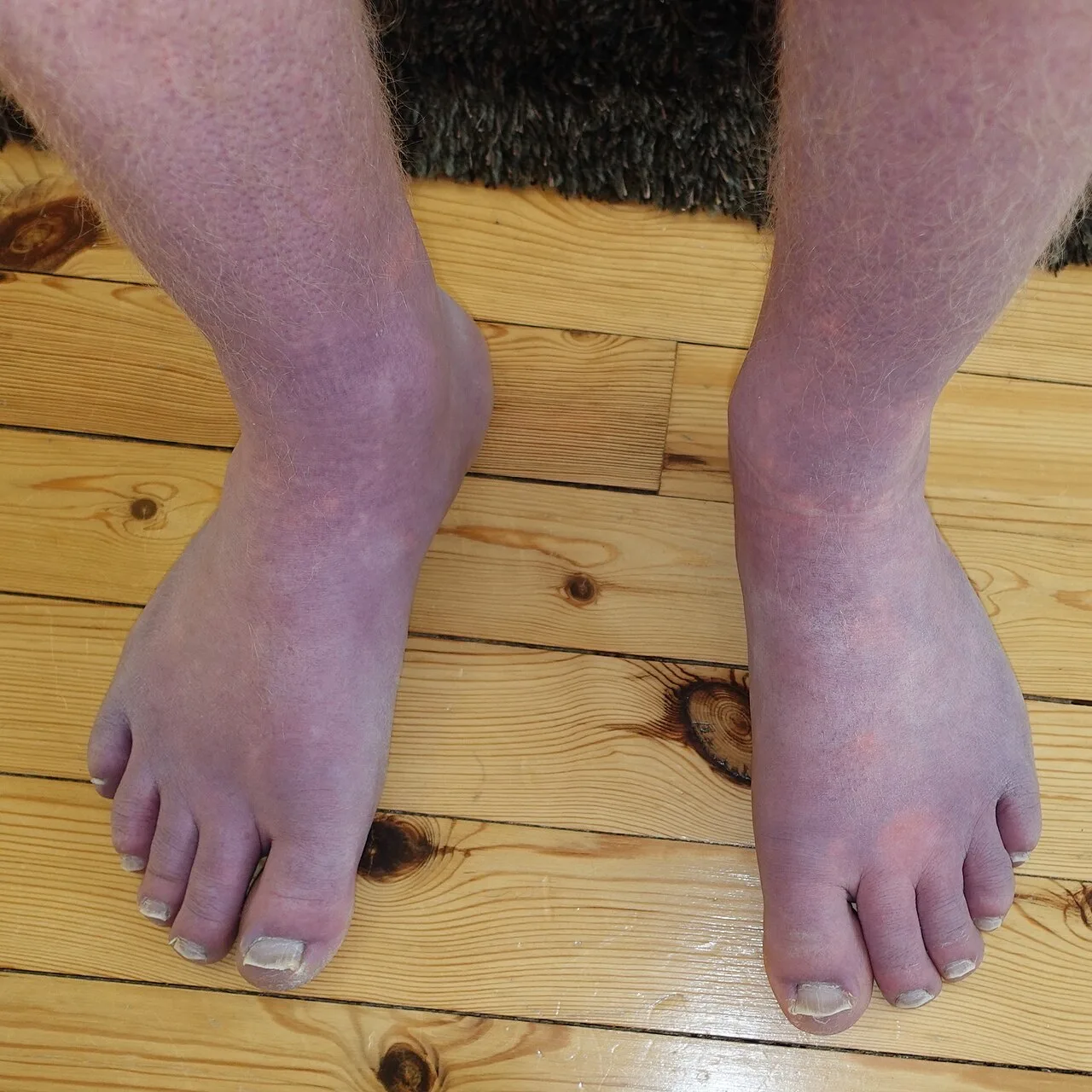 Cyanosis