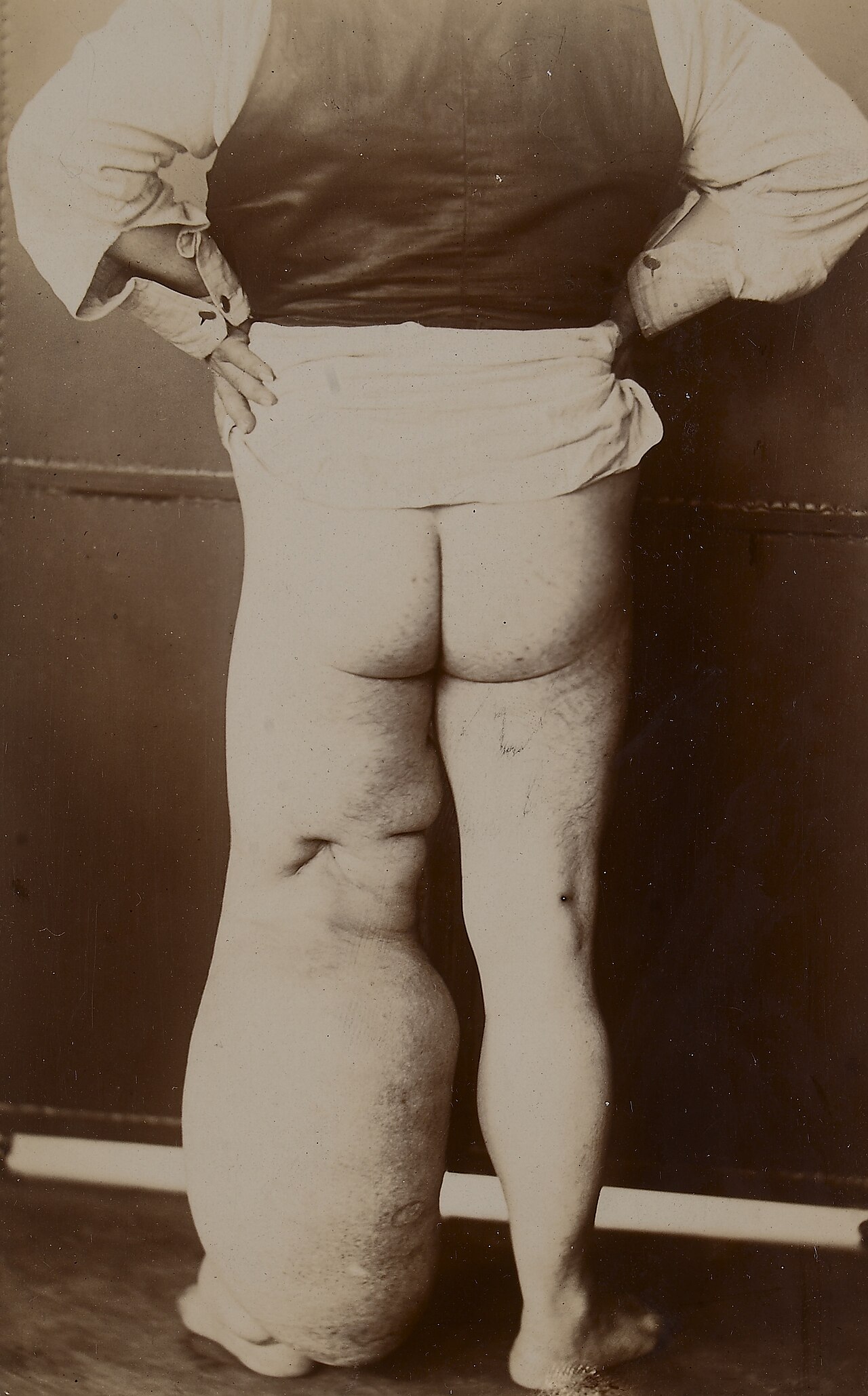 Elephantiasis