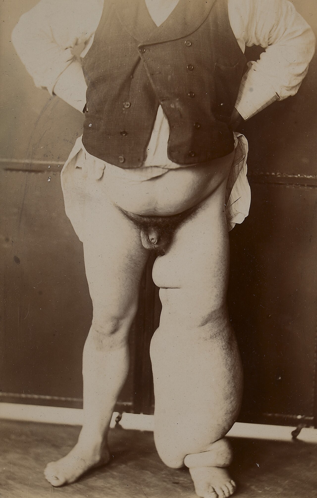 Elephantiasis