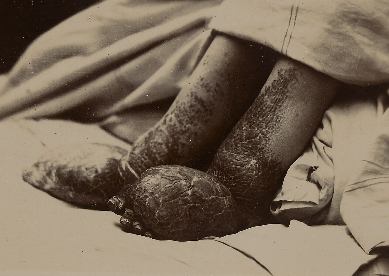 Elephantiasis