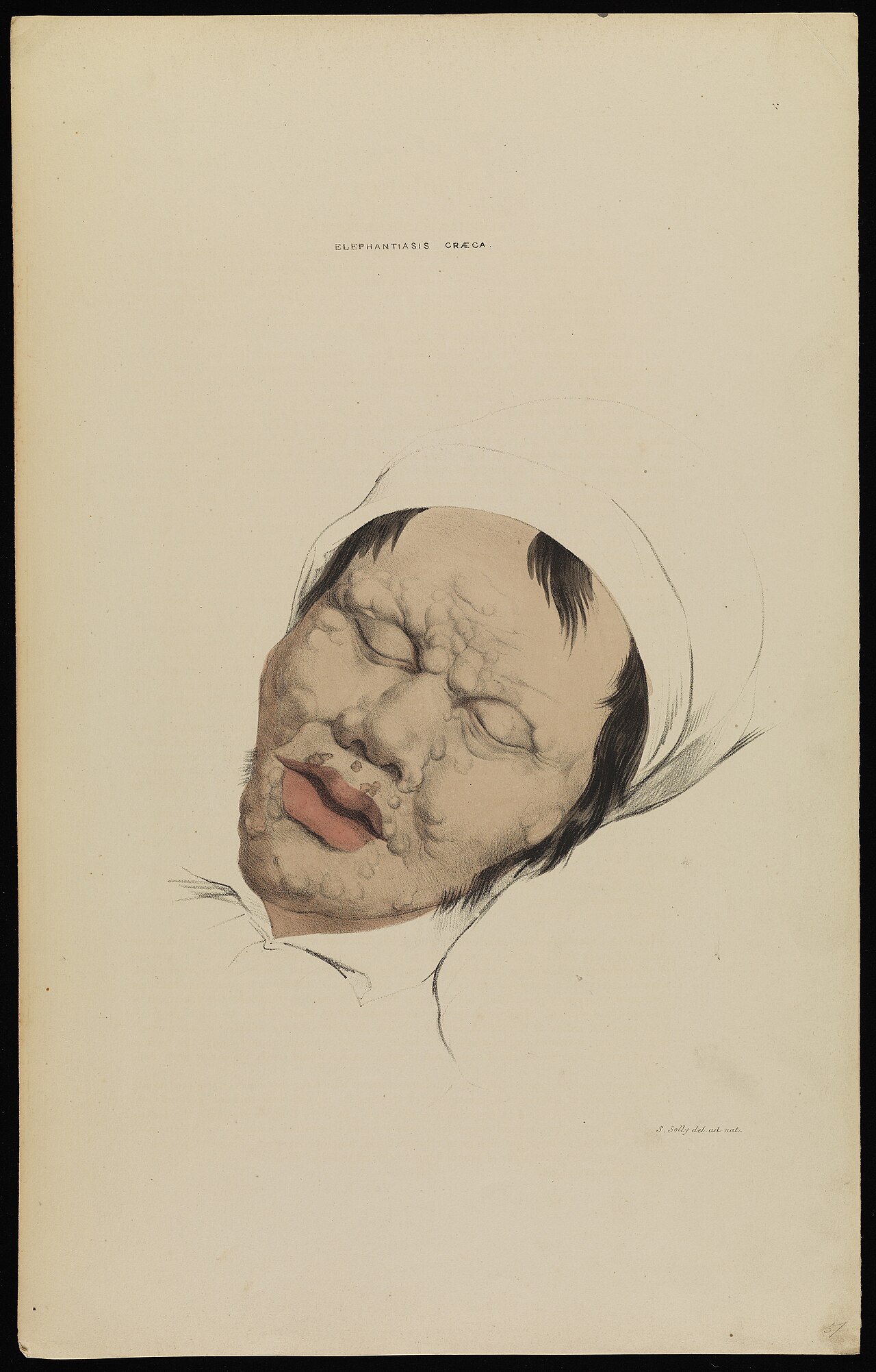 Elephantiasis