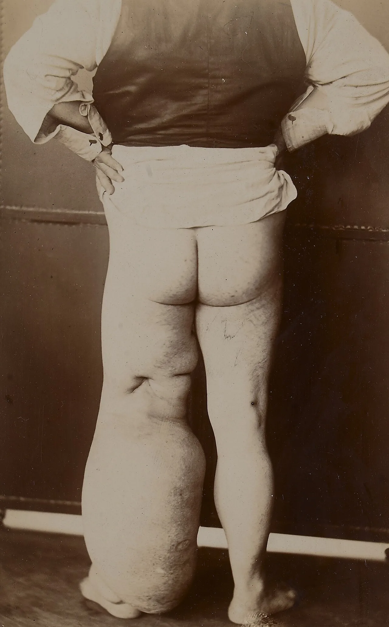 Elephantiasis