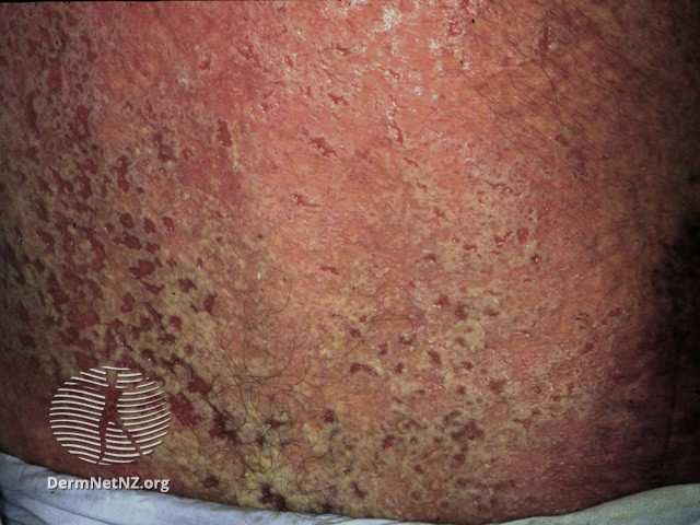 Rash