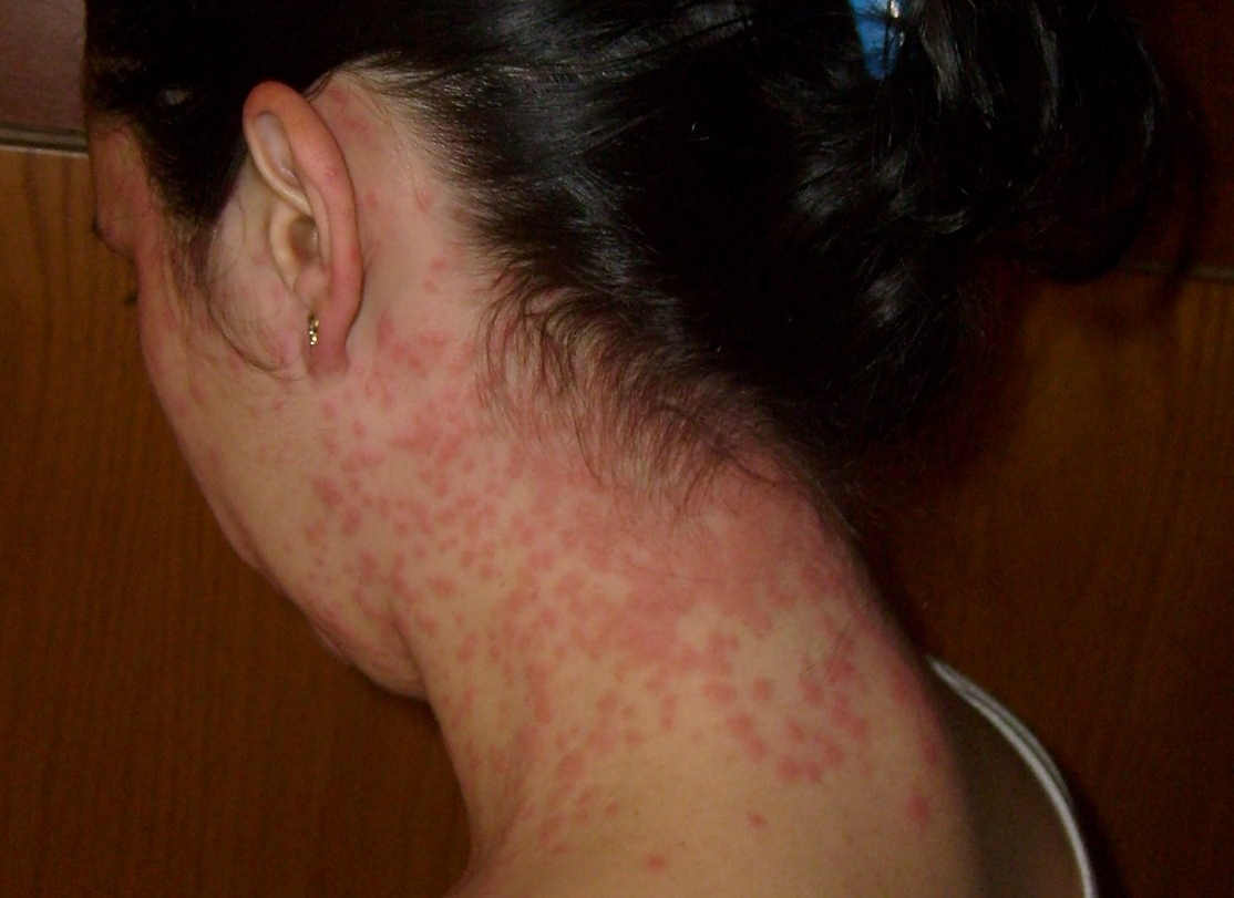 Rash