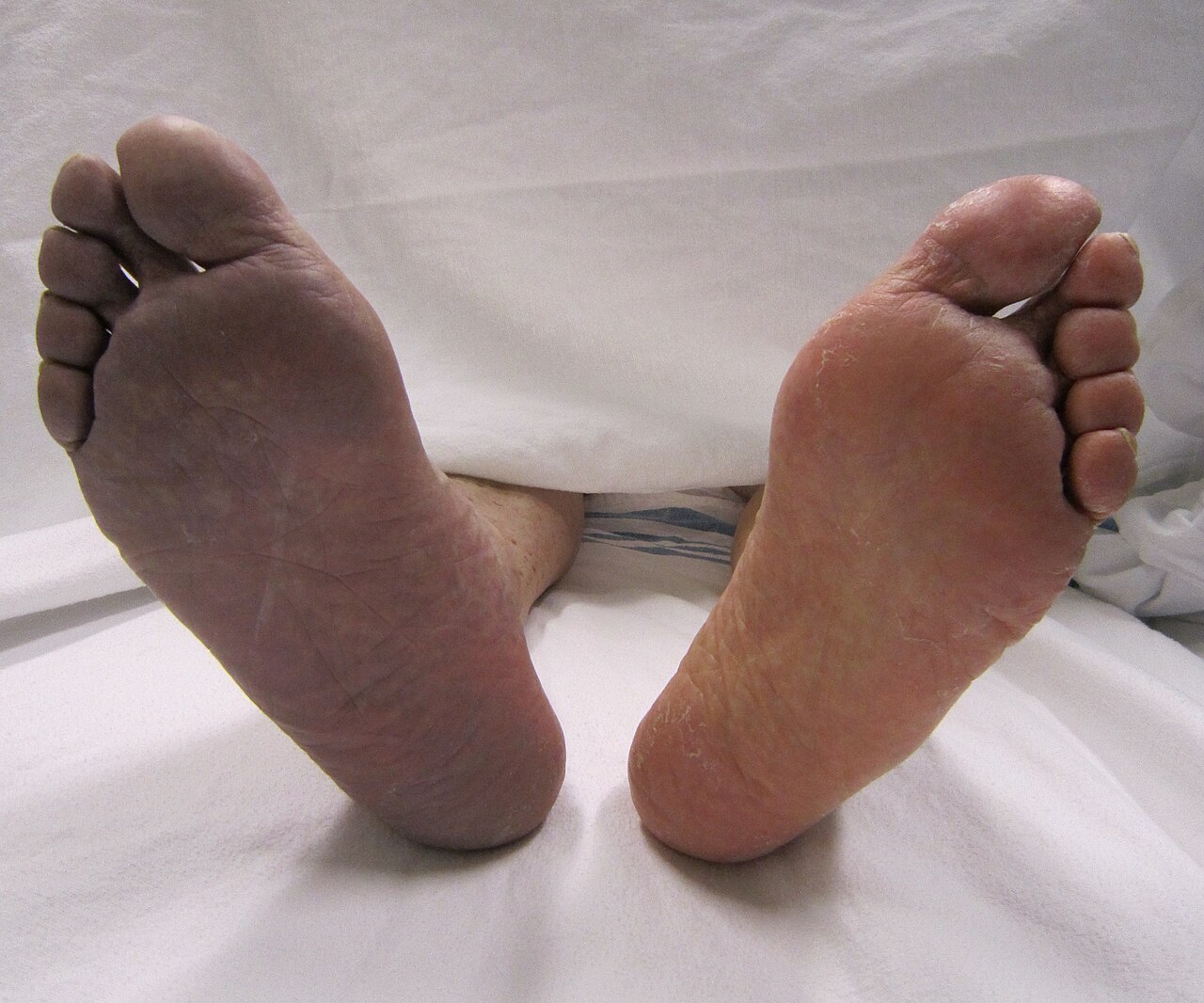 Arterial thrombosis causing cyanosis