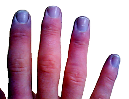 Cyanosis-adult fingertips