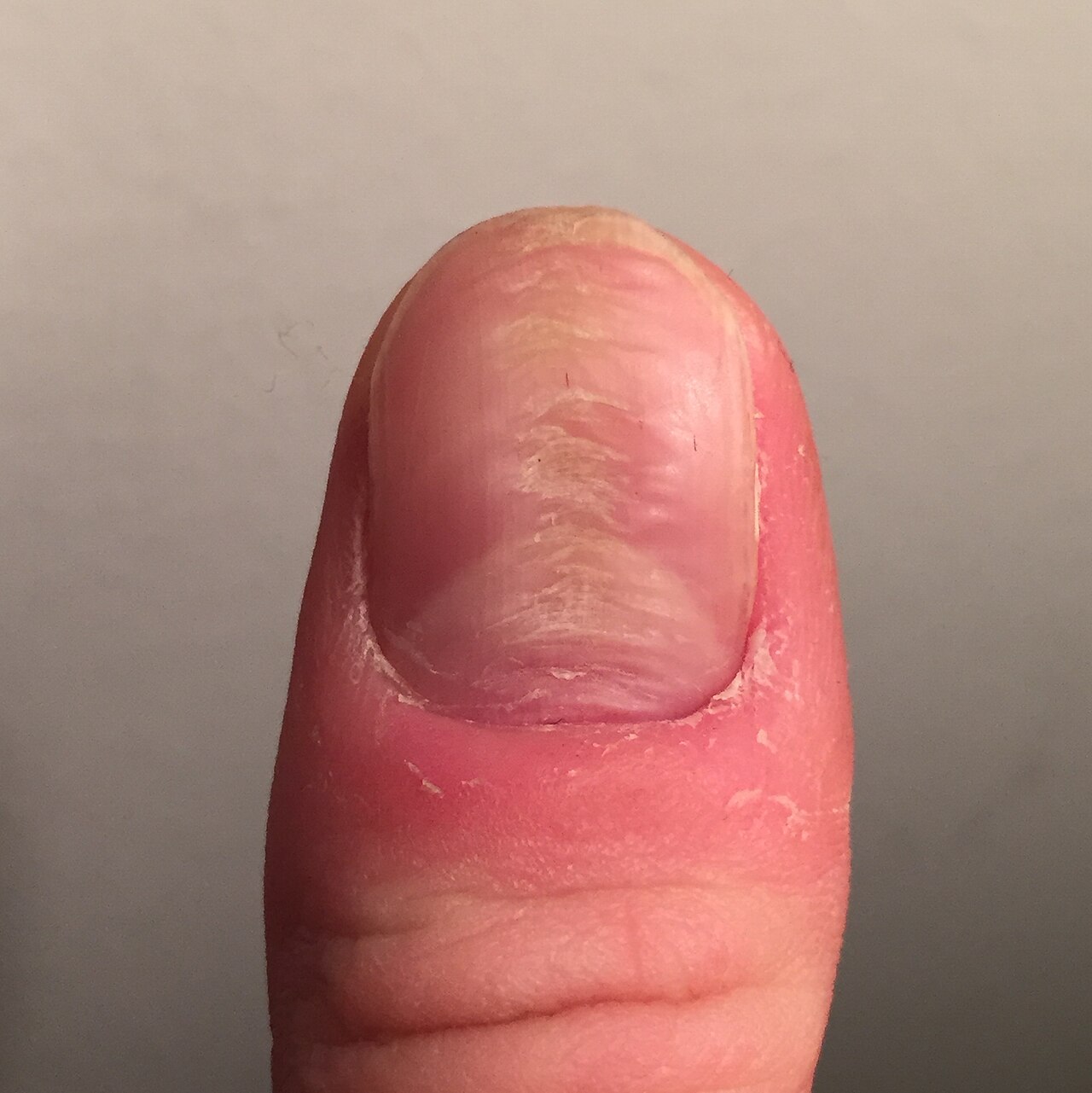 Habit-tic deformity