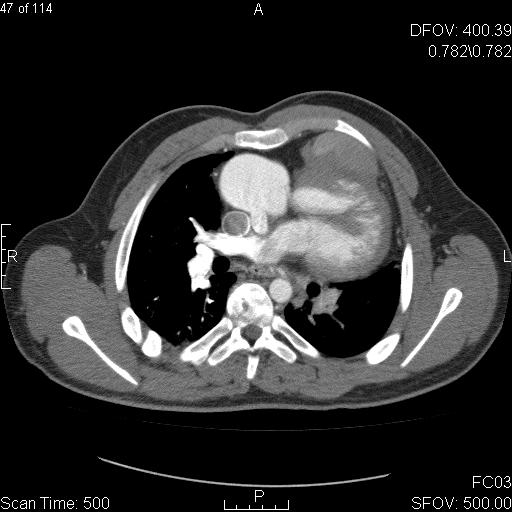 Anomalous left coronary artery from the pulmonary artery