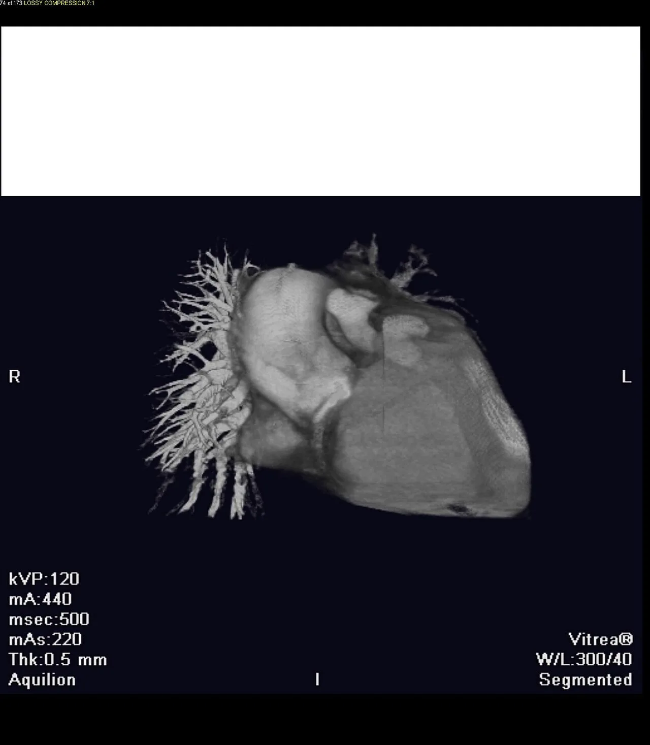 Anomalous left coronary artery from the pulmonary artery