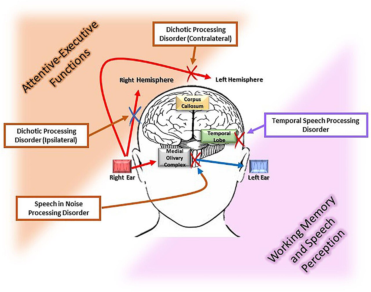 Auditory processing disorder