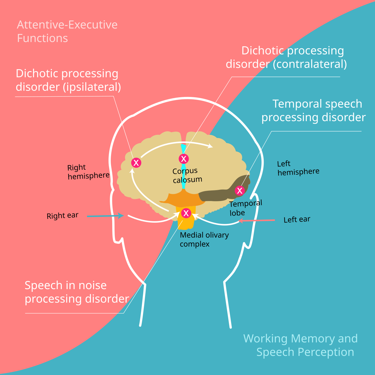 Auditory processing disorder