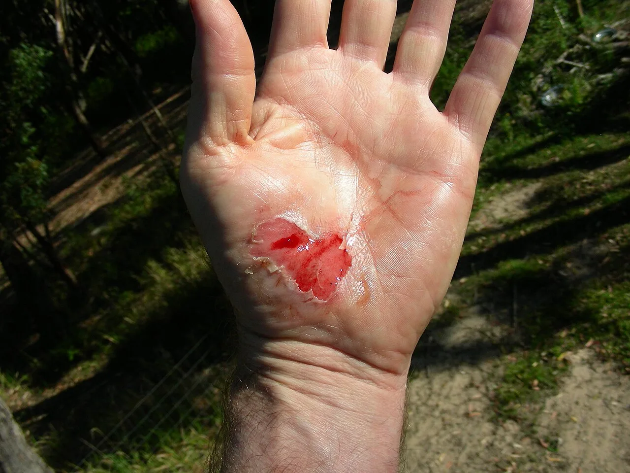 Injury