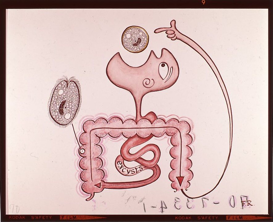 Balantidiasis