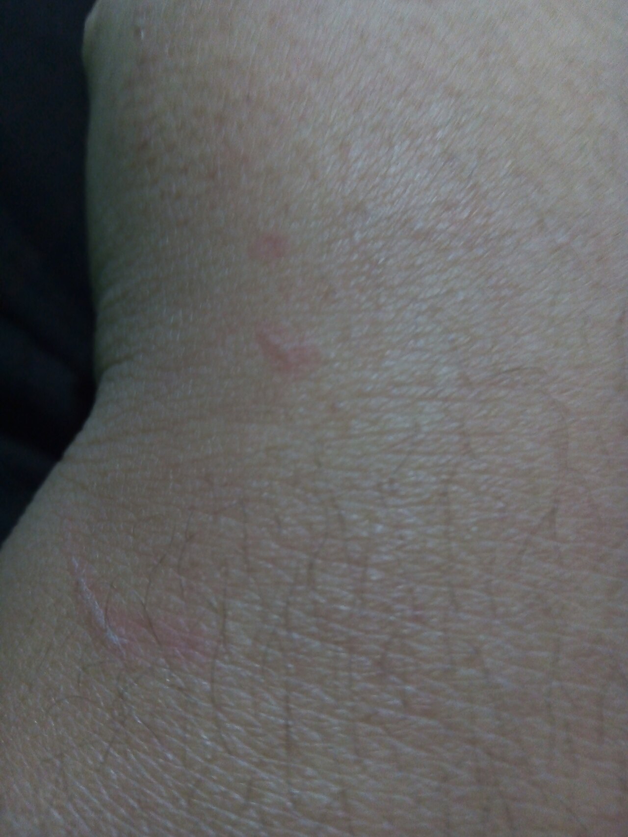 Cat bite