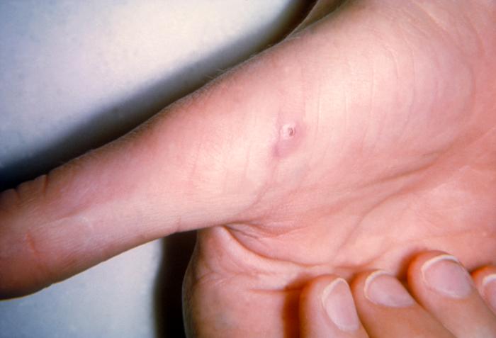 Cat-scratch disease