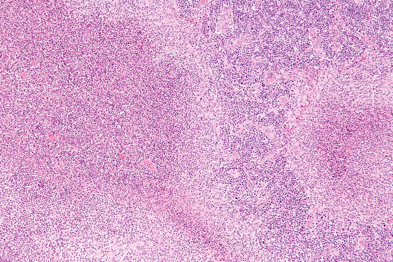 Cat-scratch disease