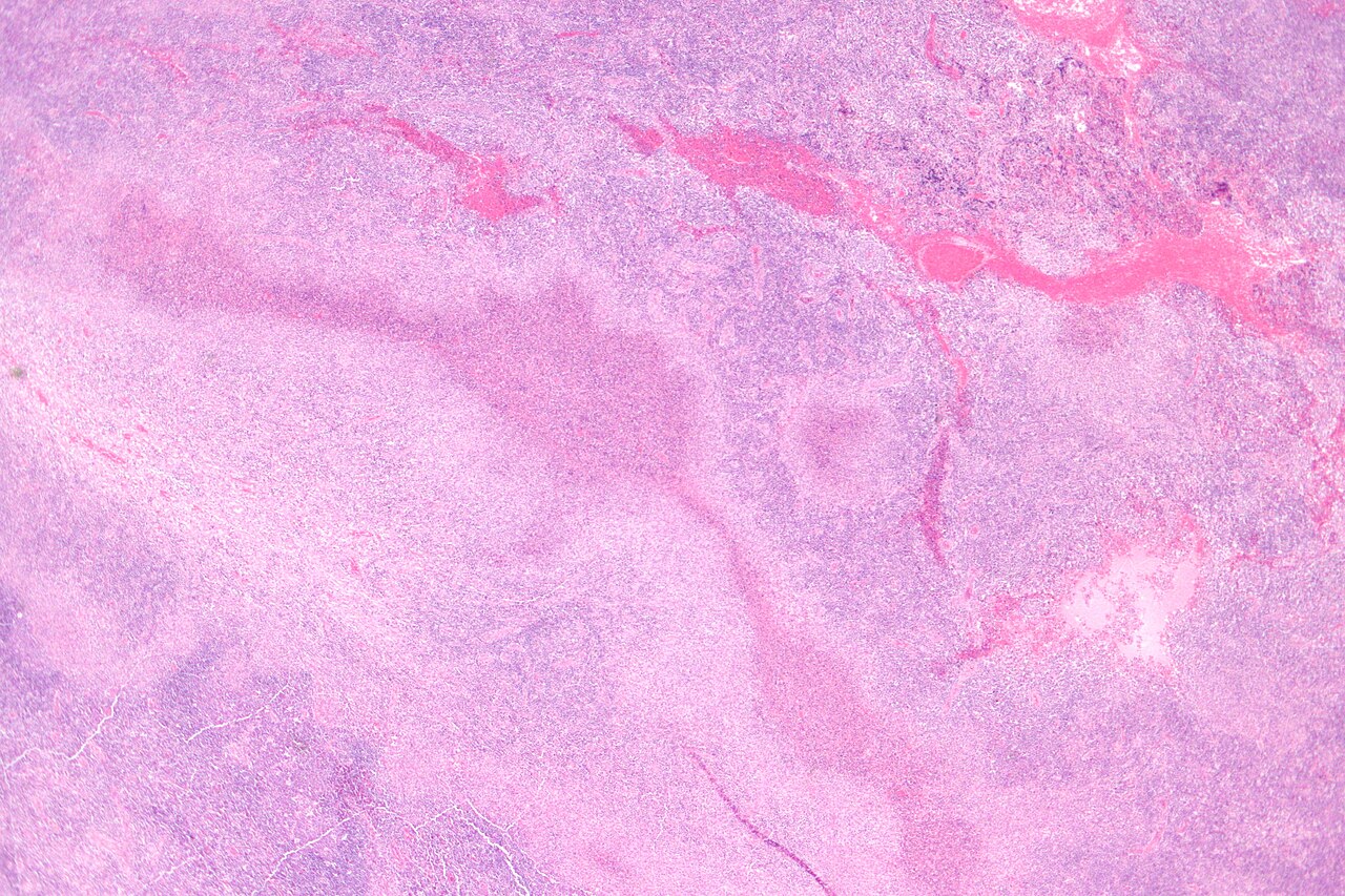 Cat-scratch disease