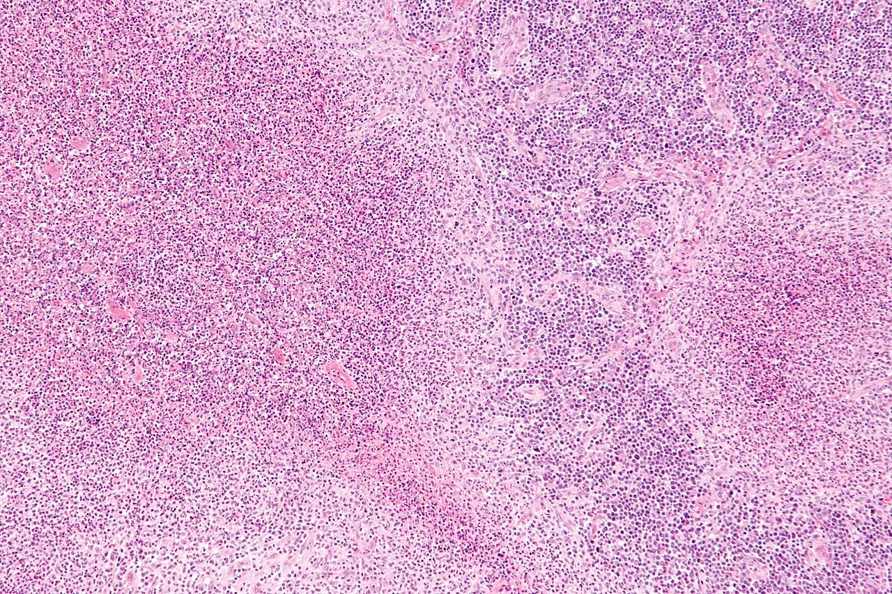 Cat-scratch disease